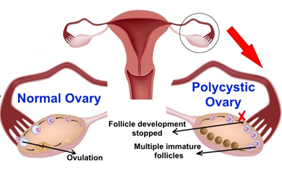 PCOS (Polycystic ovary syndrome) PCOD (Polycystic Ovarian Disease)